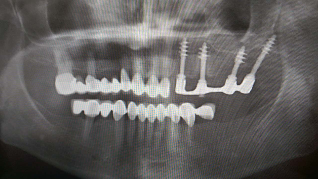 azonnal terhelhető implantátum