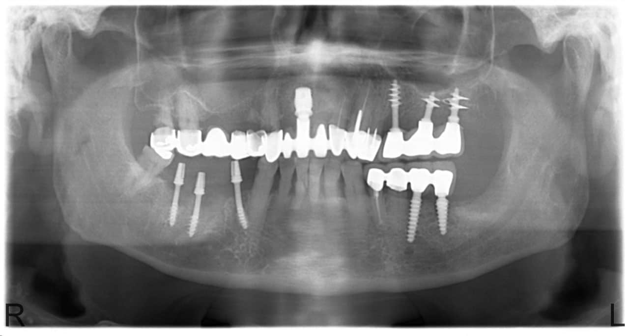 implantátum Budapest